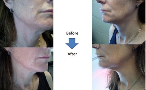 Facial Rejuvenation