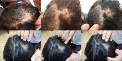 Hair Loss Case 02